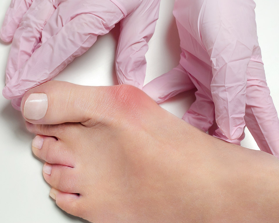 Bunions & Bunionettes Problems in Mississauga and Orangeville