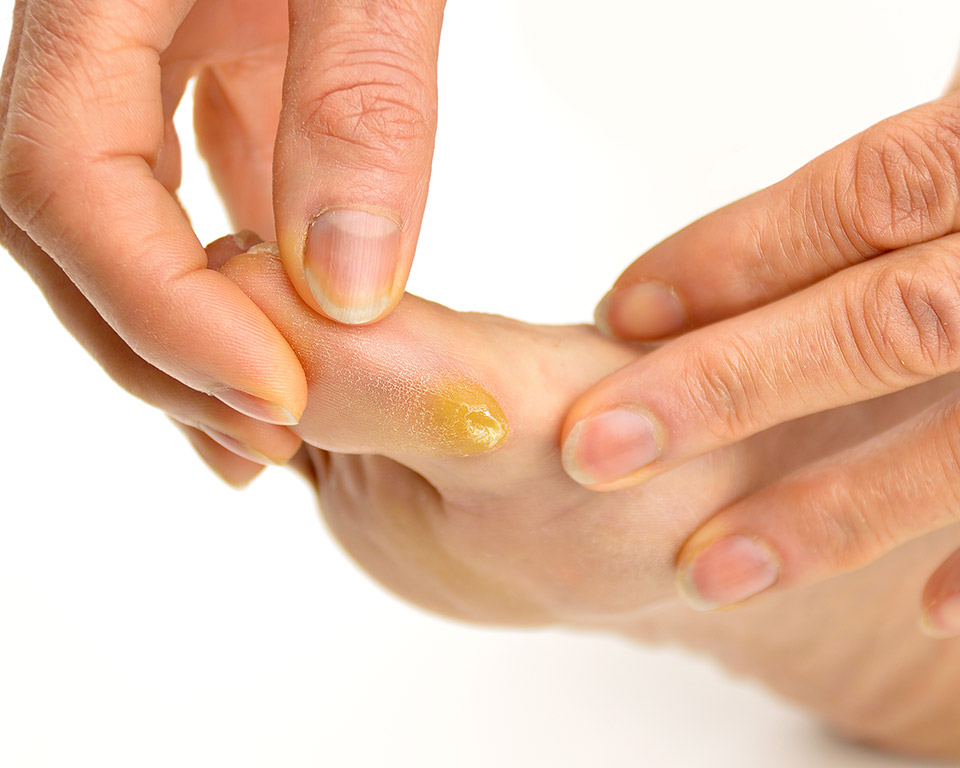 Calluses, Corns and Warts Problems in Mississauga and Orangeville
