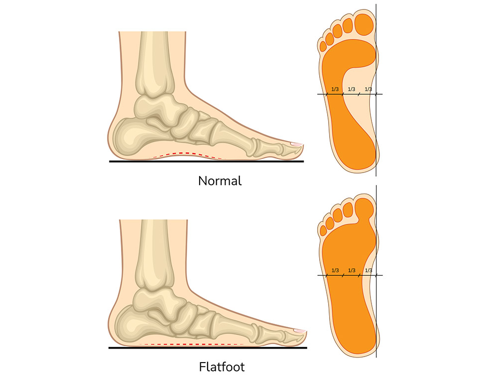 Flat Feet Problems In Mississauga And Orangeville