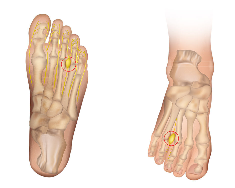 Metatarsalgia Problems in Mississauga and Orangeville